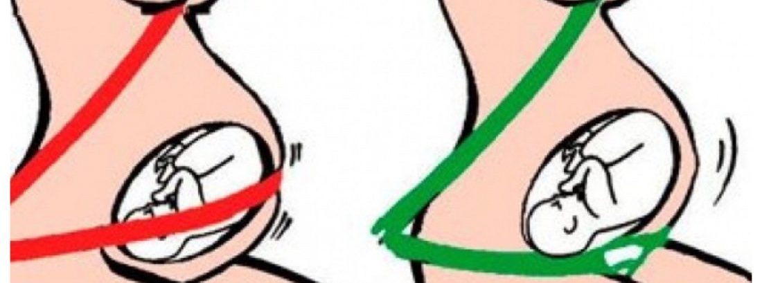 Cinto de segurança em grávida
